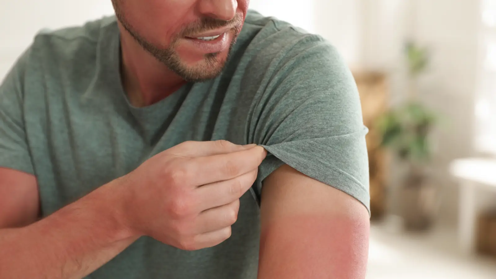 A man with sunburned skin lifting up his shirt sleeve.